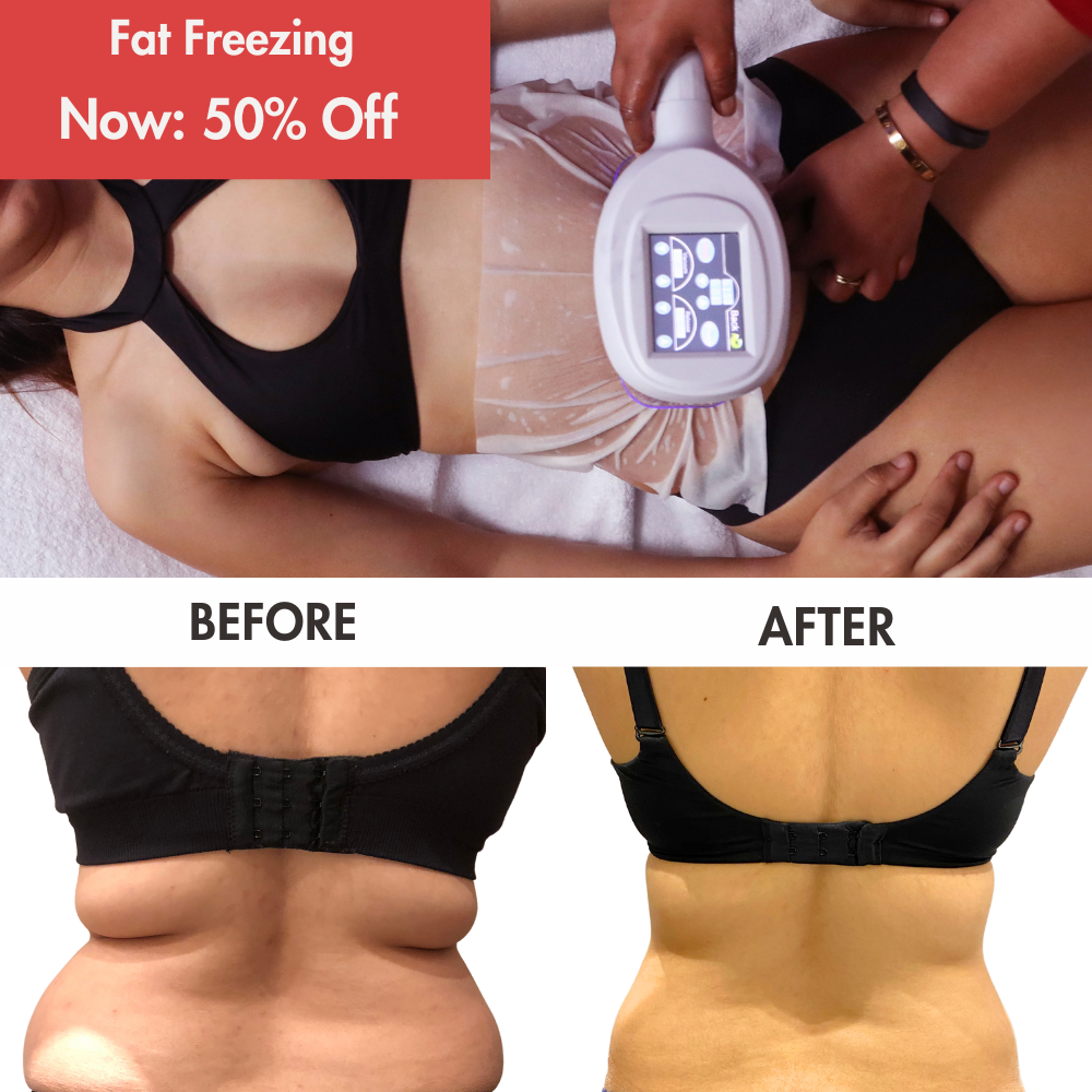 fat freeze-Jul-01-2025-12-27-30-1548-PM fat freeze-Jul-01-2025-12-27-30-1548-PM